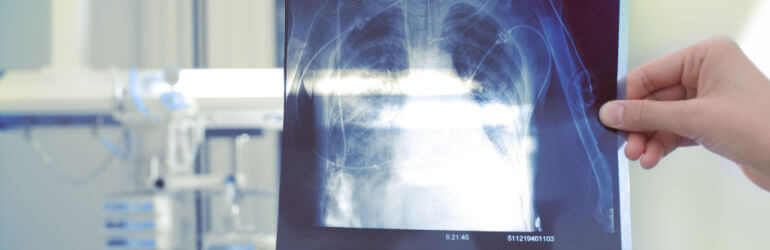 Silicosis