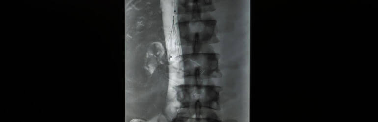 ivc filters