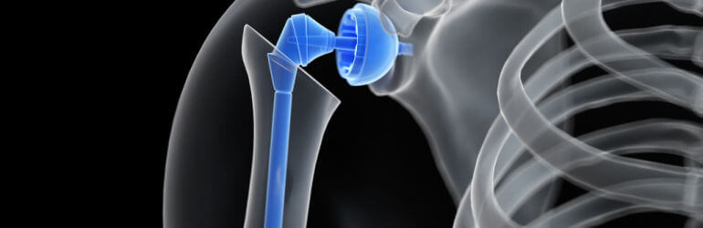 zimmer biomet shoulder