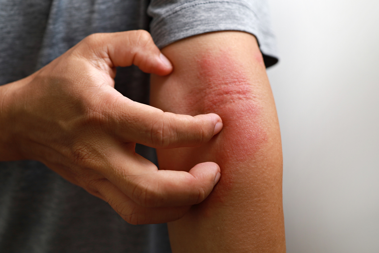 Man scratching irritated skin on arm